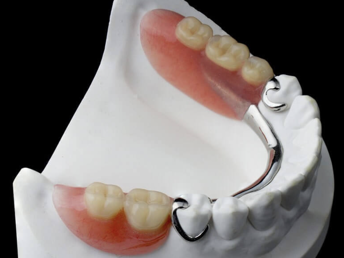 Пластинчатые зубные протезы: улучшение функции зубов и эстетики