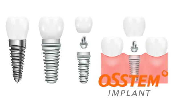 Импланты Osstem: качественная альтернатива для успешной имплантации зубов